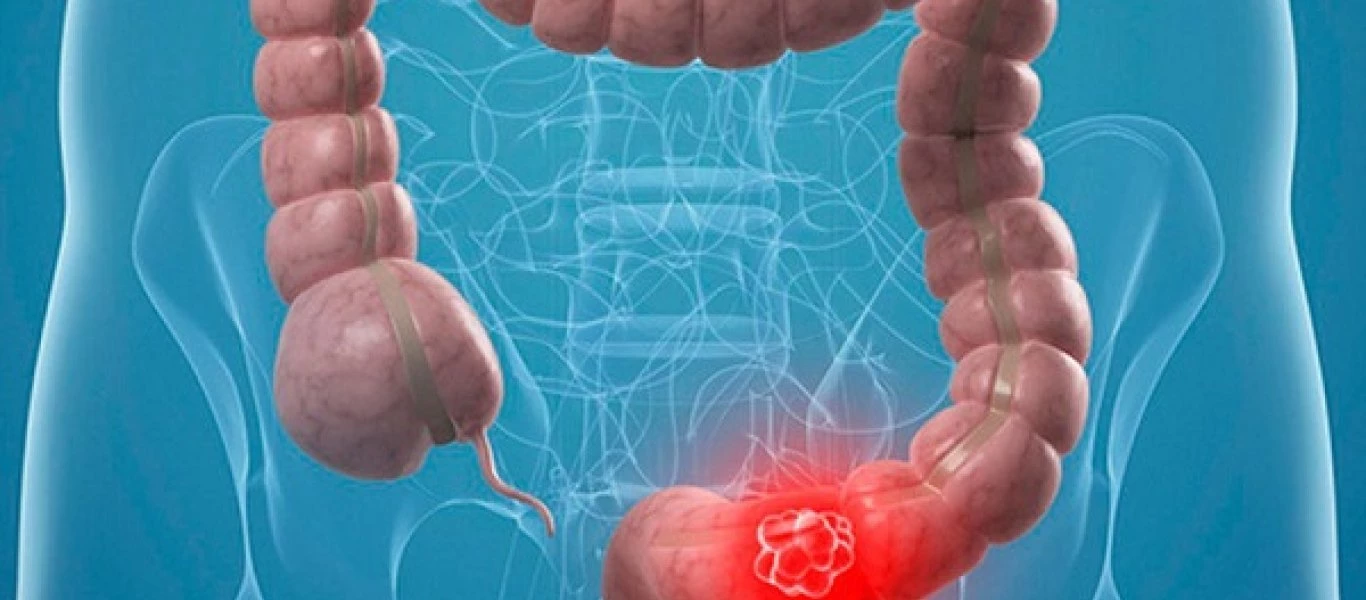 Πολύποδες παχέος εντέρου: Ποιοι κινδυνεύουν, ποιες τροφές μειώνουν τον κίνδυνο